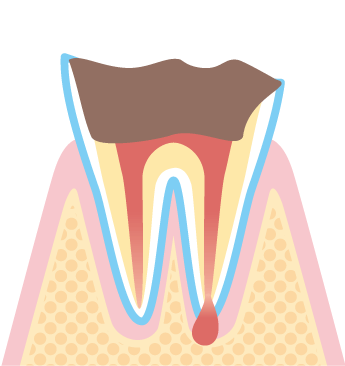 虫歯の進行4